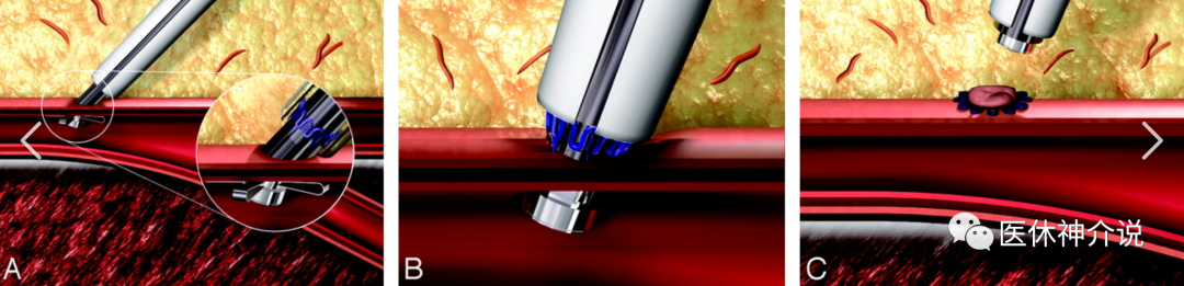 动脉什么压迫止血这些穿刺压迫方法你都会了吗？_https://www.jmylbn.com_新闻资讯_第7张