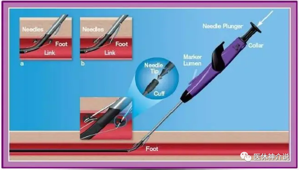 动脉什么压迫止血这些穿刺压迫方法你都会了吗？_https://www.jmylbn.com_新闻资讯_第6张