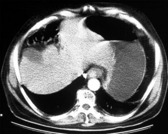 胃癌的病灶特点详情了解看这里