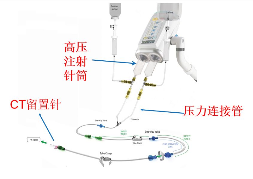 ct为什么要针筒【产品简介】高压注射针筒+压力连接管+CT留置针_https://www.jmylbn.com_新闻资讯_第1张
