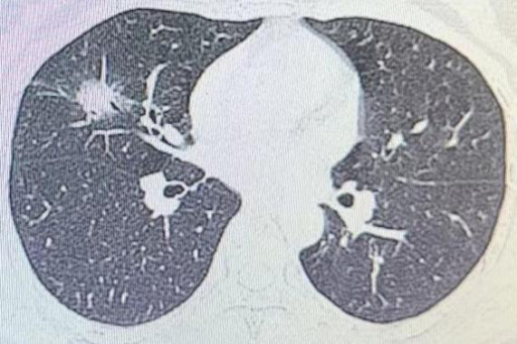 什么是数字肺线上直播肺亚段切除手术 多地数字化远程合作研讨_https://www.jmylbn.com_新闻资讯_第9张