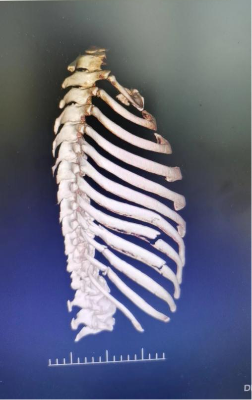 肋骨怎么记忆【科室动态】我院胸外科顺利完成记忆合金环抱器肋骨骨折切开复位内固定术_https://www.jmylbn.com_新闻资讯_第1张