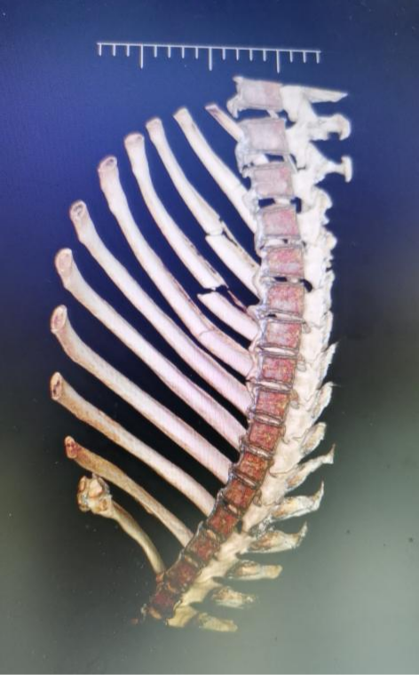 肋骨怎么记忆【科室动态】我院胸外科顺利完成记忆合金环抱器肋骨骨折切开复位内固定术_https://www.jmylbn.com_新闻资讯_第2张