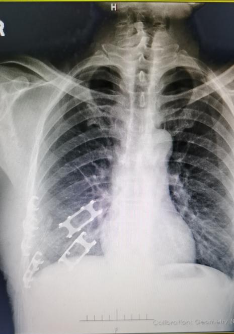 肋骨怎么记忆【科室动态】我院胸外科顺利完成记忆合金环抱器肋骨骨折切开复位内固定术_https://www.jmylbn.com_新闻资讯_第5张