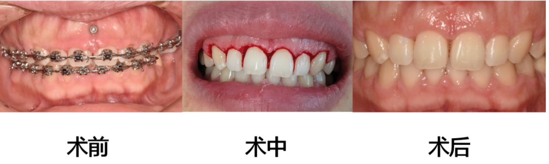 ems洁牙尖怎么分无痛的超声“洗牙”！哈医大四院口腔科引进EMS全功能牙周清洗机给牙齿做SPA_https://www.jmylbn.com_新闻资讯_第8张