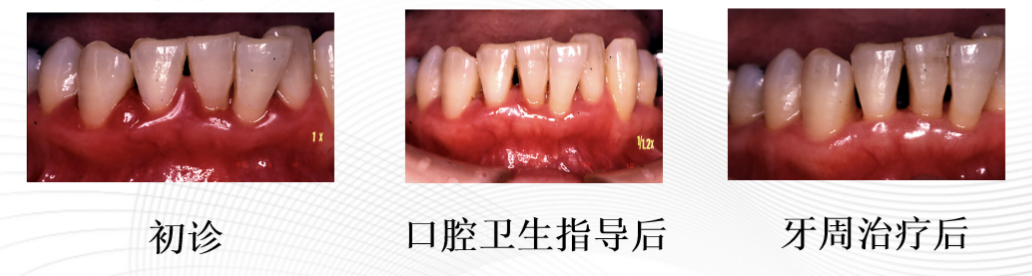 ems洁牙尖怎么分无痛的超声“洗牙”！哈医大四院口腔科引进EMS全功能牙周清洗机给牙齿做SPA_https://www.jmylbn.com_新闻资讯_第5张