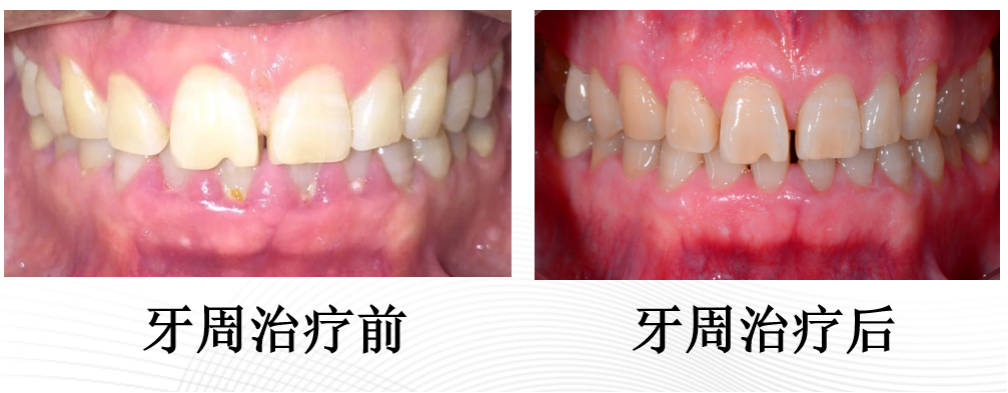 ems洁牙尖怎么分无痛的超声“洗牙”！哈医大四院口腔科引进EMS全功能牙周清洗机给牙齿做SPA_https://www.jmylbn.com_新闻资讯_第6张