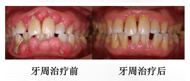ems洁牙尖怎么分无痛的超声“洗牙”！哈医大四院口腔科引进EMS全功能牙周清洗机给牙齿做SPA_https://www.jmylbn.com_新闻资讯_第7张