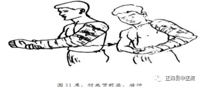 上肢怎么康复【正中医｜科普】上肢骨折术后如何正确的进行康复锻炼_https://www.jmylbn.com_新闻资讯_第19张