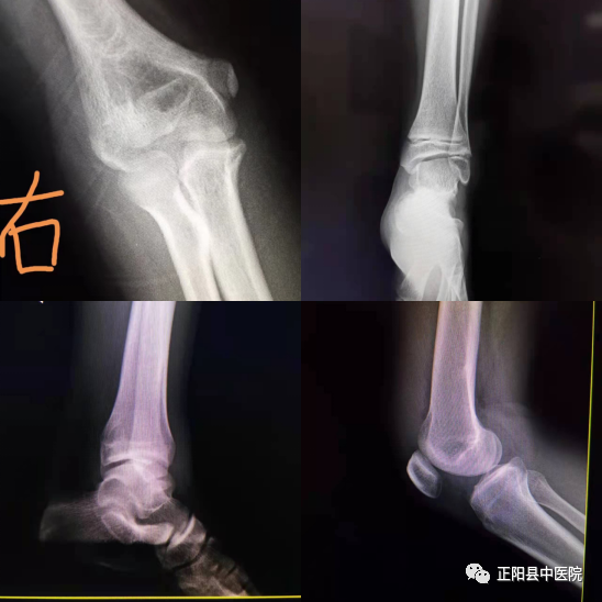 dr拍片怎么拍清晰【正中医｜科普】为什么四肢关节DR拍片时，常规为正侧位片？_https://www.jmylbn.com_新闻资讯_第5张