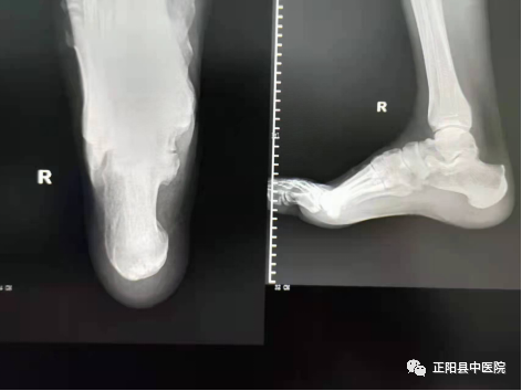 dr拍片怎么拍清晰【正中医｜科普】为什么四肢关节DR拍片时，常规为正侧位片？_https://www.jmylbn.com_新闻资讯_第7张