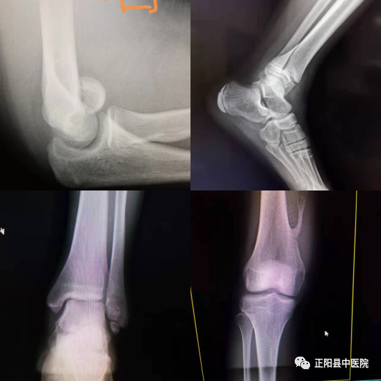 dr拍片怎么拍清晰【正中医｜科普】为什么四肢关节DR拍片时，常规为正侧位片？_https://www.jmylbn.com_新闻资讯_第6张