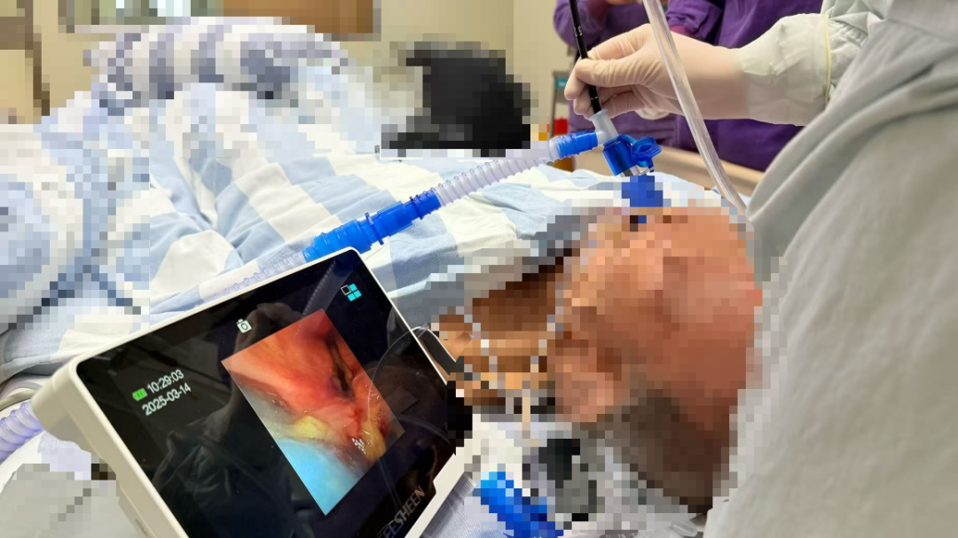 为什么要用喉罩走进重症监护室——小喉罩，大作用！_https://www.jmylbn.com_新闻资讯_第10张