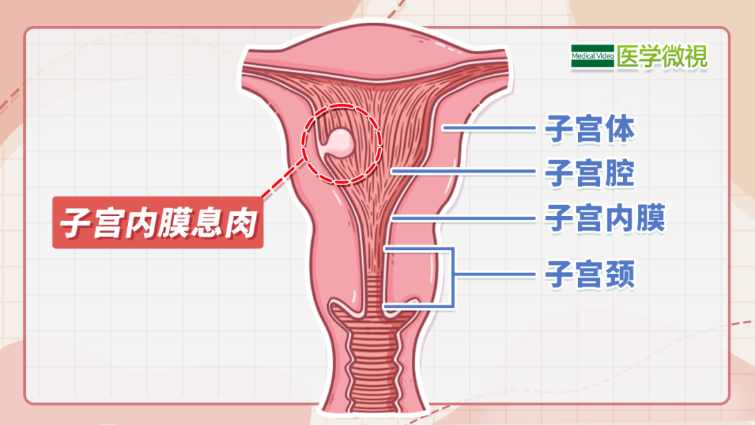 子宫内膜息肉会癌变吗 要手术吗 全网搜