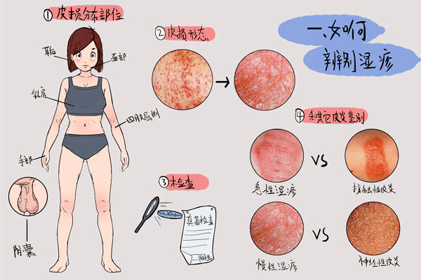 诱发成人长湿疹的原因你知道吗 赶快来了解一下 资讯 苏州视点网