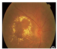 彩色眼底照相查什么2024全国爱眼日｜ 眼底一张照，眼病早知道_https://www.jmylbn.com_新闻资讯_第2张