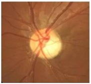 彩色眼底照相查什么2024全国爱眼日｜ 眼底一张照，眼病早知道_https://www.jmylbn.com_新闻资讯_第4张