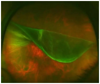 彩色眼底照相查什么2024全国爱眼日｜ 眼底一张照，眼病早知道_https://www.jmylbn.com_新闻资讯_第3张