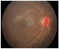 彩色眼底照相查什么2024全国爱眼日｜ 眼底一张照，眼病早知道_https://www.jmylbn.com_新闻资讯_第1张