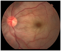 彩色眼底照相查什么2024全国爱眼日｜ 眼底一张照，眼病早知道_https://www.jmylbn.com_新闻资讯_第5张