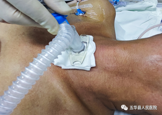 五华县人民医院重症医学科开展安全可靠全程可视下经皮穿刺气管切开术