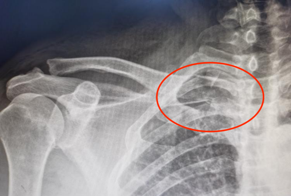 Illustration 2 for 锁骨近端复杂骨折不再愁！DR CT X片精准解读，cc胸锁钩钢板低风险手术新突破，实现快速康复！