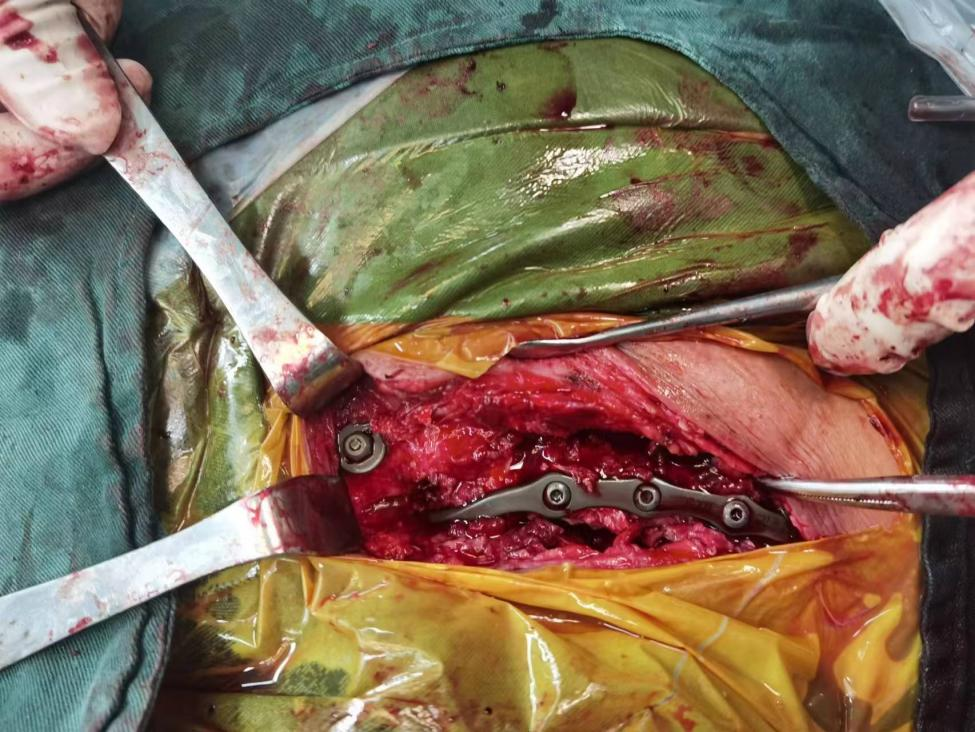 Illustration 4 for 锁骨近端复杂骨折不再愁！DR CT X片精准解读，cc胸锁钩钢板低风险手术新突破，实现快速康复！