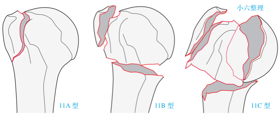 图文详解：肱骨大结节骨折的关节镜治疗
