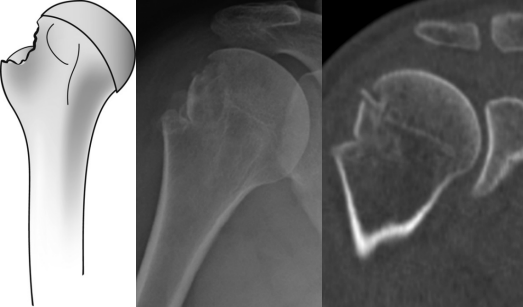 图文详解：肱骨大结节骨折的关节镜治疗