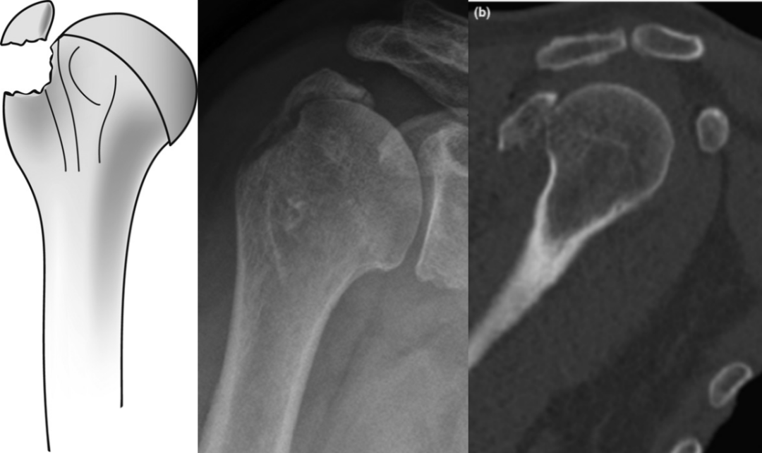 图文详解：肱骨大结节骨折的关节镜治疗