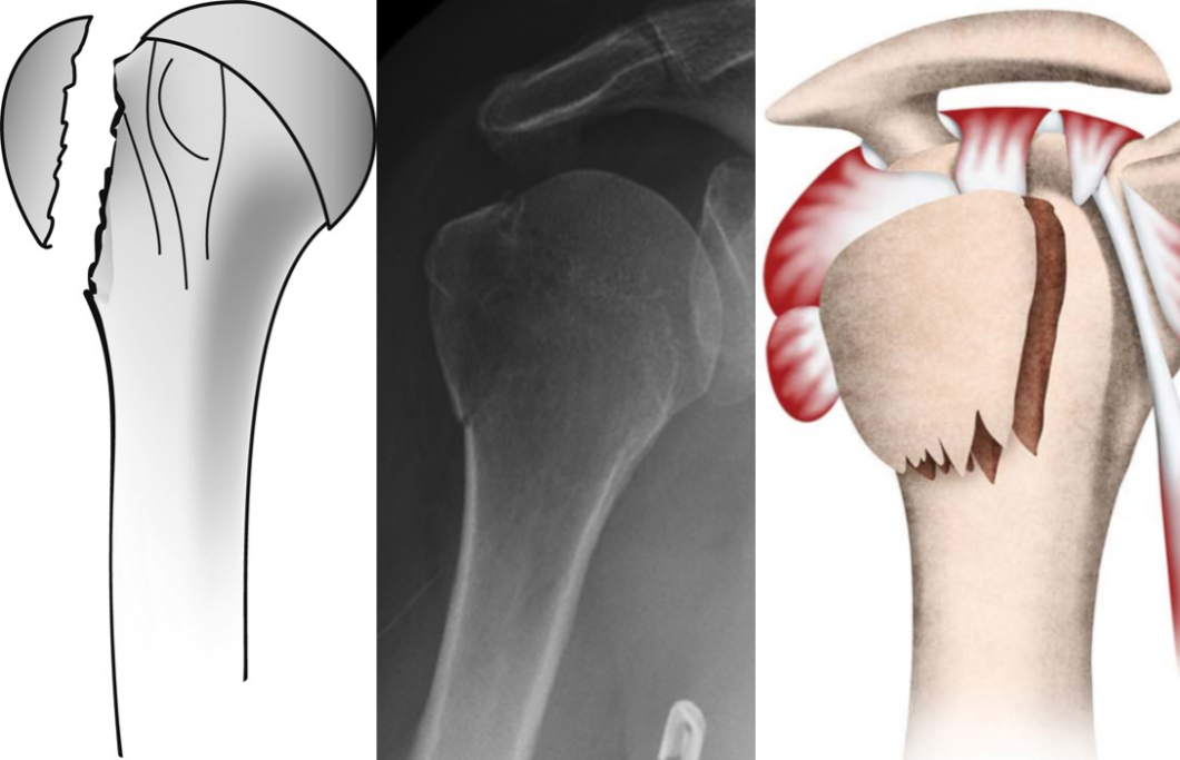 图文详解：肱骨大结节骨折的关节镜治疗