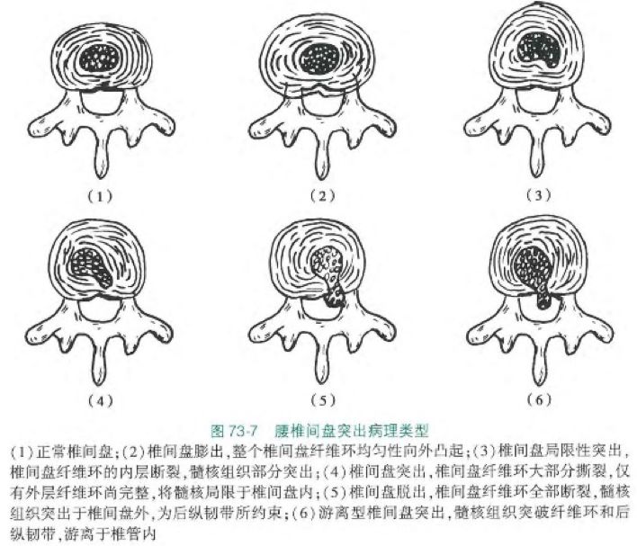 腰椎间盘突出症 症状侧与突出侧不符怎么办 颈肩腰腿痛中心 微信公众号文章阅读 Wemp