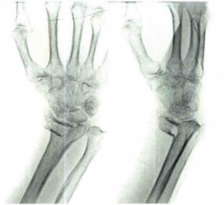 医疗康复包括什么骨质疏松性骨折：诊断、治疗和康复一文整理！_https://www.jmylbn.com_新闻资讯_第28张