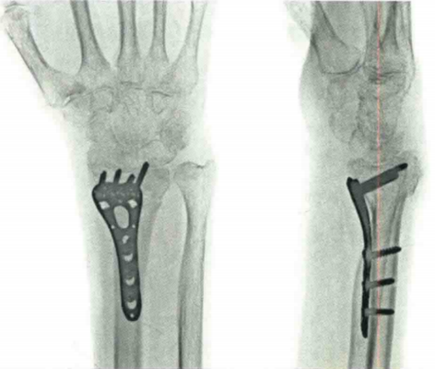 医疗康复包括什么骨质疏松性骨折：诊断、治疗和康复一文整理！_https://www.jmylbn.com_新闻资讯_第29张
