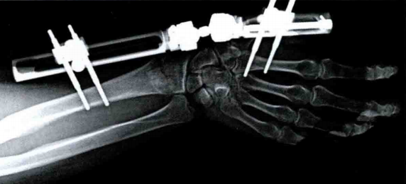 医疗康复包括什么骨质疏松性骨折：诊断、治疗和康复一文整理！_https://www.jmylbn.com_新闻资讯_第30张