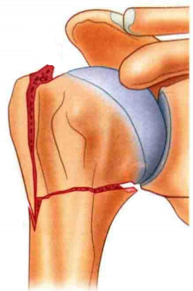 医疗康复包括什么骨质疏松性骨折：诊断、治疗和康复一文整理！_https://www.jmylbn.com_新闻资讯_第31张