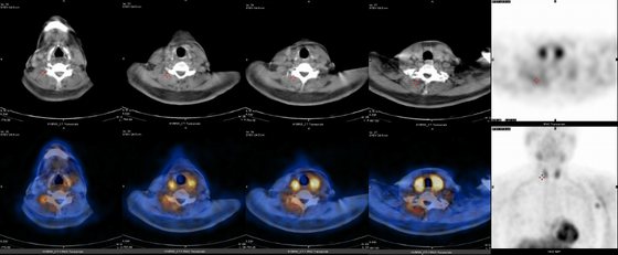 d-spect怎么检查【科普周刊245期】“歪脖子病”怎么办，核医学99mTc-MIBI SPECT／CT检查来助力_https://www.jmylbn.com_新闻资讯_第3张