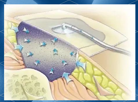 怎么促进vsd伤口愈合VSD技术，让伤口愈合更轻松_https://www.jmylbn.com_新闻资讯_第2张