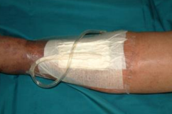 怎么促进vsd伤口愈合VSD技术，让伤口愈合更轻松_https://www.jmylbn.com_新闻资讯_第3张