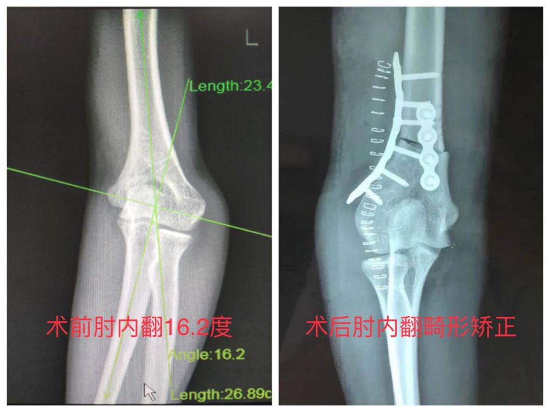 矫形手术治疗骨折畸形患者 冀中能源峰峰集团总医院 微信公众号文章阅读 Wemp