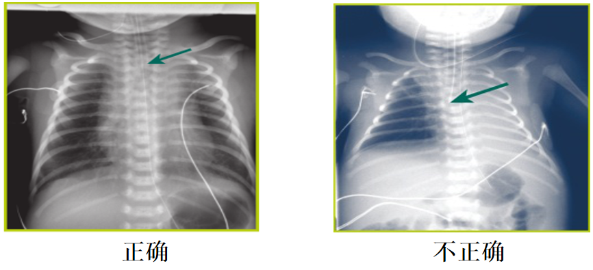 喉镜镜片怎么选【新生儿复苏概论】中国新生儿窒息复苏项目标准（2020版）第五期：气管插管和喉罩气道_https://www.jmylbn.com_新闻资讯_第16张