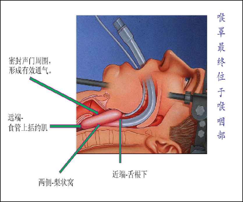 喉镜镜片怎么选【新生儿复苏概论】中国新生儿窒息复苏项目标准（2020版）第五期：气管插管和喉罩气道_https://www.jmylbn.com_新闻资讯_第22张