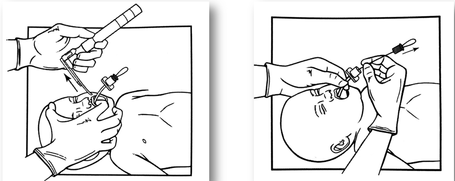 喉镜镜片怎么选【新生儿复苏概论】中国新生儿窒息复苏项目标准（2020版）第五期：气管插管和喉罩气道_https://www.jmylbn.com_新闻资讯_第13张