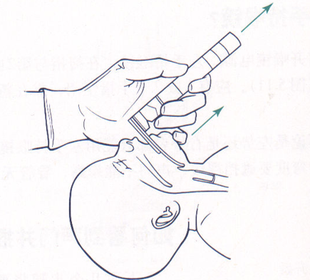 喉镜镜片怎么选【新生儿复苏概论】中国新生儿窒息复苏项目标准（2020版）第五期：气管插管和喉罩气道_https://www.jmylbn.com_新闻资讯_第10张