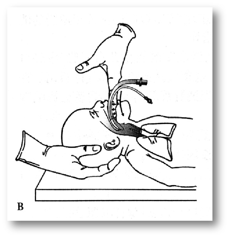 喉镜镜片怎么选【新生儿复苏概论】中国新生儿窒息复苏项目标准（2020版）第五期：气管插管和喉罩气道_https://www.jmylbn.com_新闻资讯_第20张