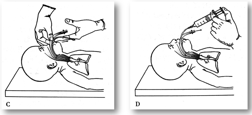 喉镜镜片怎么选【新生儿复苏概论】中国新生儿窒息复苏项目标准（2020版）第五期：气管插管和喉罩气道_https://www.jmylbn.com_新闻资讯_第21张