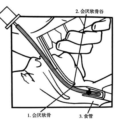 喉镜镜片怎么选【新生儿复苏概论】中国新生儿窒息复苏项目标准（2020版）第五期：气管插管和喉罩气道_https://www.jmylbn.com_新闻资讯_第12张