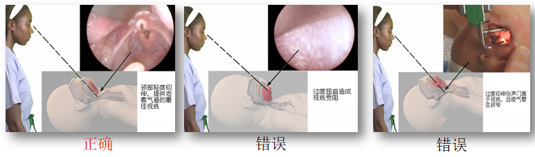 喉镜镜片怎么选【新生儿复苏概论】中国新生儿窒息复苏项目标准（2020版）第五期：气管插管和喉罩气道_https://www.jmylbn.com_新闻资讯_第8张