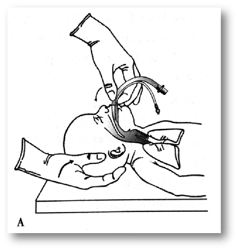 喉镜镜片怎么选【新生儿复苏概论】中国新生儿窒息复苏项目标准（2020版）第五期：气管插管和喉罩气道_https://www.jmylbn.com_新闻资讯_第19张