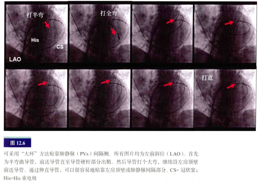 介入怎么进导管介入秘籍：心脏导管操作技巧_https://www.jmylbn.com_新闻资讯_第7张